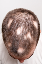 Alopecia Areata